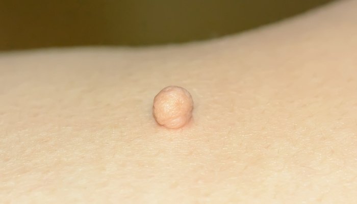 A close look at a skin tag.