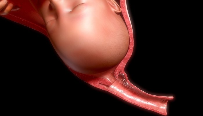 An illustration depicting the early stages of effacement and dilation.