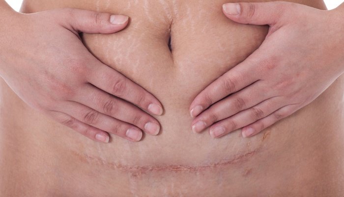 A new mother holding her belly to show the C-section incision.