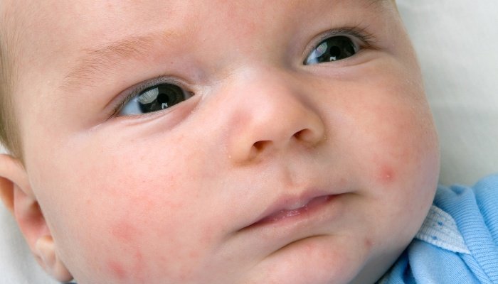An up-close look at a small amount of acne on a newborn's face.
