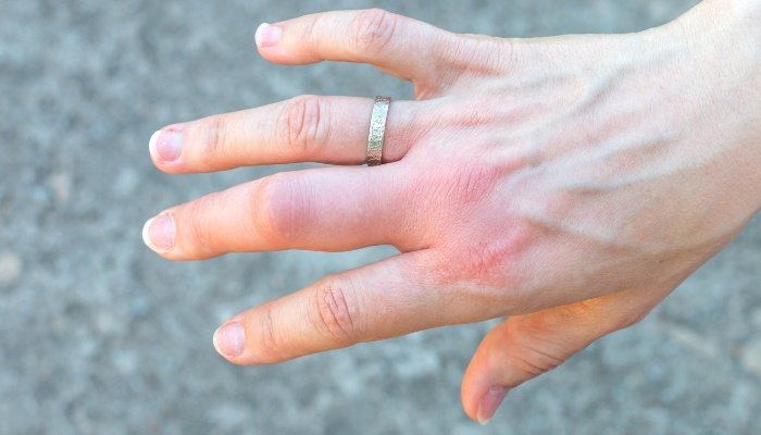 A woman's right hand experiencing swelling after a bee sting.
